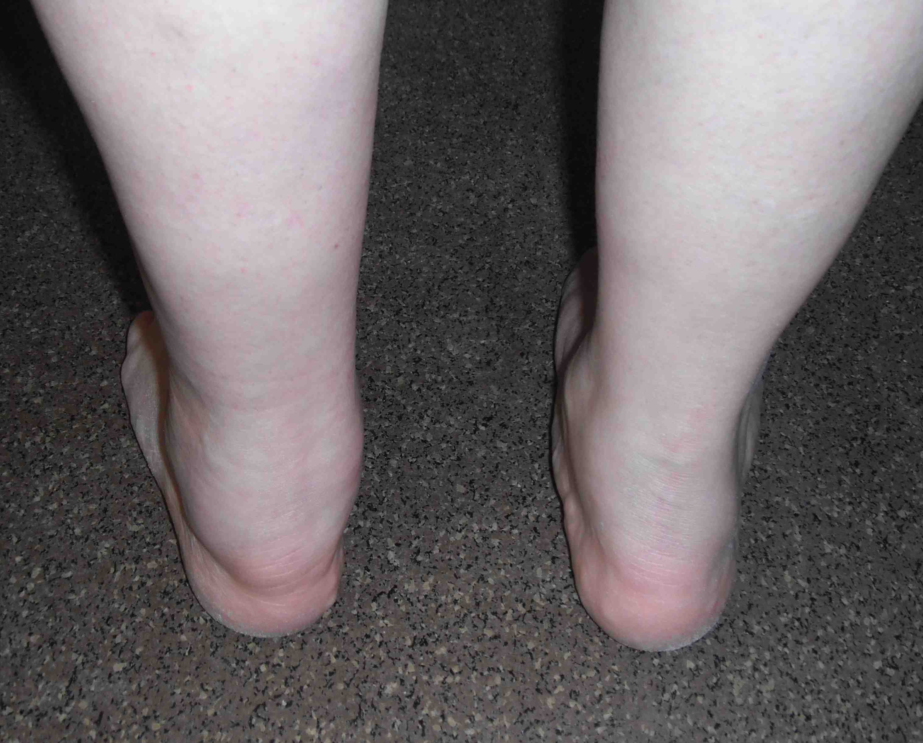 Ankle Synovitis